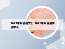 2023年银屑病支出 2021年银屑病有望根治