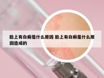 脸上有白癣是什么原因 脸上有白癣是什么原因造成的