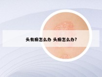 头有癣怎么办 头癣怎么办?
