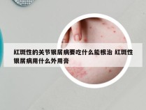红斑性的关节银屑病要吃什么能根治 红斑性银屑病用什么外用膏