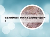 银屑病结痂变白 银屑病皮肤结痂是不是好转了