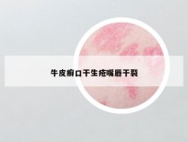 牛皮癣口干生疮嘴唇干裂