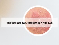 银屑病感冒怎么办 银屑病感冒了吃什么药