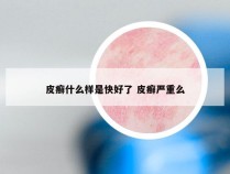 皮癣什么样是快好了 皮癣严重么