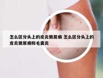 怎么区分头上的皮炎银屑病 怎么区分头上的皮炎银屑病和毛囊炎