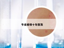 牛皮癣带十年假发