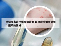 昆明哪家治疗银屑病最好 昆明治疗银屑病哪个医院效果好