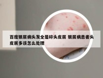 百度银屑病头发全是碎头皮屑 银屑病患者头皮屑多该怎么处理
