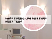 牛皮癣有屑子能搽他扎罗疔 头部银屑病可以抹他扎罗汀乳膏吗