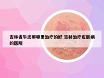 吉林省牛皮癣哪里治疗的好 吉林治疗皮肤病的医院