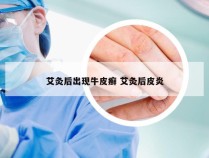 艾灸后出现牛皮癣 艾灸后皮炎