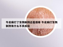 牛皮癣打了生物制剂还是很痒 牛皮癣打生物制剂有什么不良反应