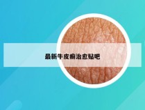 最新牛皮癣治愈贴吧