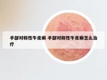 手部对称性牛皮癣 手部对称性牛皮癣怎么治疗