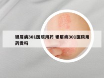 银屑病301医院用药 银屑病301医院用药贵吗
