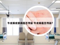 牛皮癣皮肤病是否传染 牛皮癣是否传染?