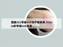 德国311窄谱uvb治疗银屑病 311nm的窄谱uvb危害