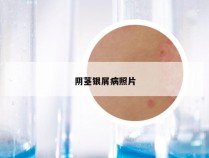 阴茎银屑病照片