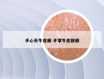 手心长牛皮癣 手掌牛皮肤癣