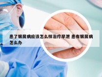 患了银屑病应该怎么样治疗早泄 患有银屑病怎么办