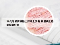 20几年银屑病脸上脖子上没有 银屑病上脸能彻底好吗