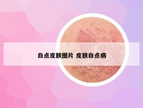 白点皮肤图片 皮肤白点病
