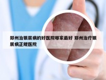 郑州治银屑病的好医院哪家最好 郑州治疗银屑病正规医院