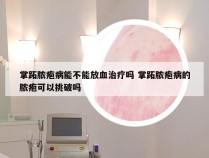掌跖脓疱病能不能放血治疗吗 掌跖脓疱病的脓疱可以挑破吗