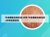 牛皮癣能吃维生素c片吗 牛皮癣能吃维生素c片吗百度百科