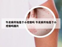 牛皮癣开始是个小疙瘩吗 牛皮癣开始是个小疙瘩吗图片