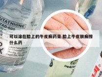 可以涂在脸上的牛皮癣药膏 脸上牛皮肤癣擦什么药