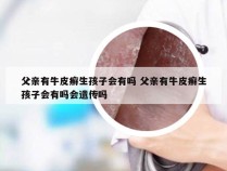 父亲有牛皮癣生孩子会有吗 父亲有牛皮癣生孩子会有吗会遗传吗