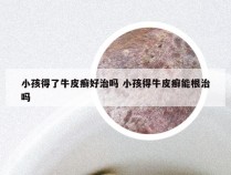小孩得了牛皮癣好治吗 小孩得牛皮癣能根治吗
