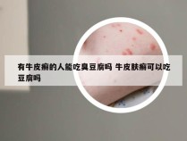 有牛皮癣的人能吃臭豆腐吗 牛皮肤癣可以吃豆腐吗
