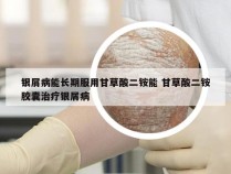 银屑病能长期服用甘草酸二铵能 甘草酸二铵胶囊治疗银屑病