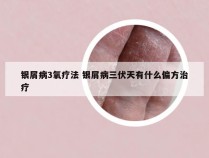 银屑病3氧疗法 银屑病三伏天有什么偏方治疗