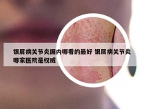 银屑病关节炎国内哪看的最好 银屑病关节炎哪家医院是权威