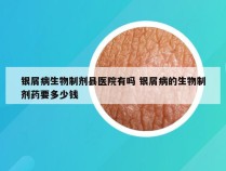 银屑病生物制剂县医院有吗 银屑病的生物制剂药要多少钱
