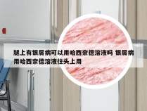 腿上有银屑病可以用哈西奈德溶液吗 银屑病用哈西奈德溶液往头上用