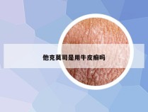 他克莫司是用牛皮癣吗