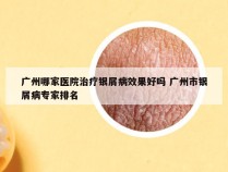 广州哪家医院治疗银屑病效果好吗 广州市银屑病专家排名