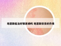 地蒽酚能治好银屑病吗 地蒽酚软膏的作用