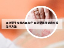 血热型牛皮癣怎么治疗 血热型银屑病最有效治疗方法