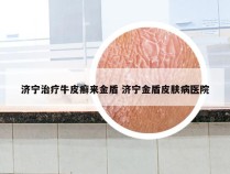 济宁治疗牛皮癣来金盾 济宁金盾皮肤病医院