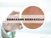 银屑病头皮发臭吗 银屑病头皮该怎么办