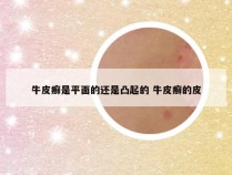 牛皮癣是平面的还是凸起的 牛皮癣的皮