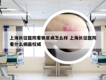 上海长征医院看银屑病怎么样 上海长征医院看什么病最权威