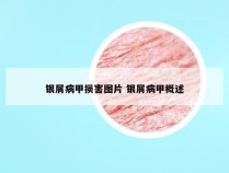 银屑病甲损害图片 银屑病甲概述