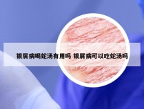 银屑病喝蛇汤有用吗 银屑病可以吃蛇汤吗