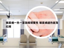 银屑病一热一紧张痒得要死 银屑病遇热就发红痒